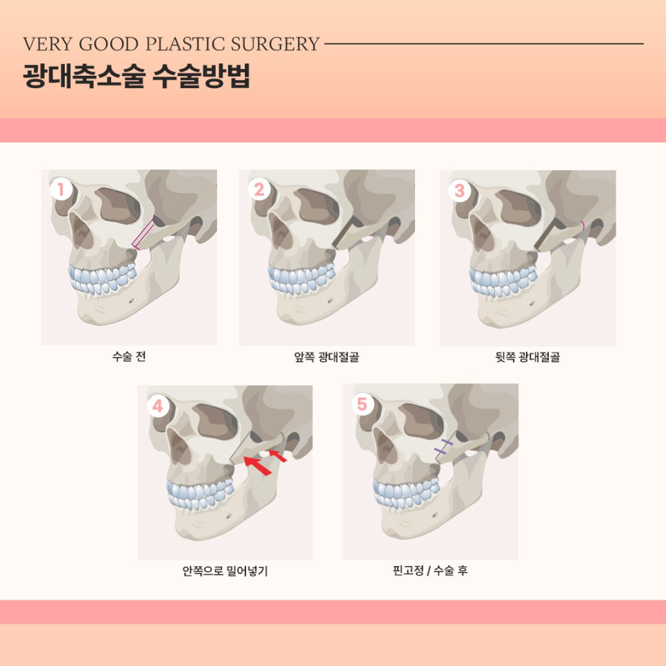 베리굿성형외과 광대축소술, 쉐딩이 필요없는 정면에서도 작아 보이는 입체 윤곽라인 관련 이미지 3
