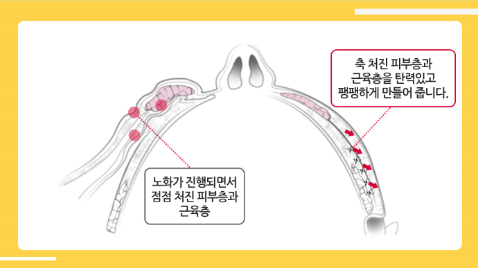 안면거상 깊은 주름에 효과적인 동안수술 관련 이미지 4