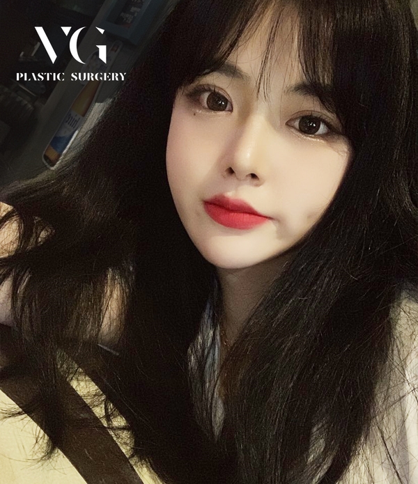 얼굴지방흡입비용 갸름한 얼굴라인을 원한다면? 관련 이미지 1