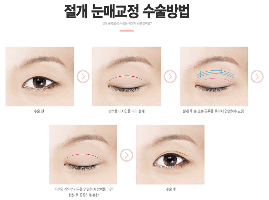 남자눈매교정전후 확실하게 관련 이미지 5