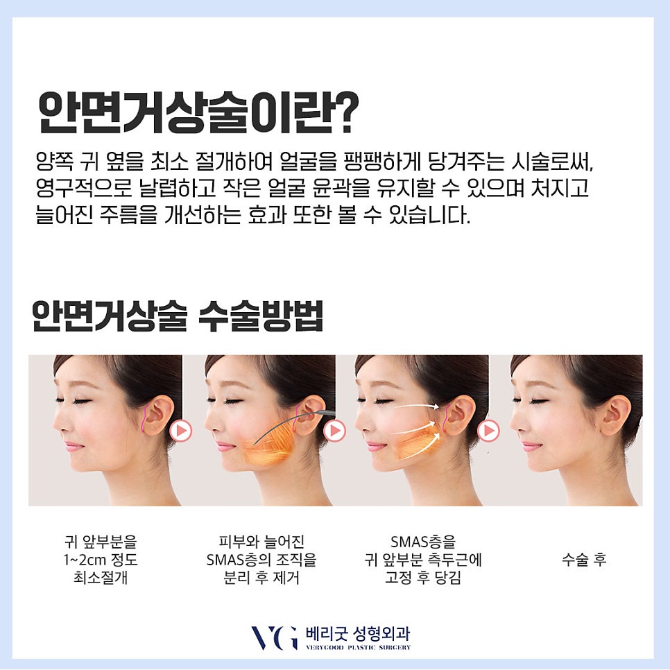 중년 여성 실리프팅, 안면거상술｜얼굴 주름 및 심부볼 처짐 개선! 관련 이미지 5