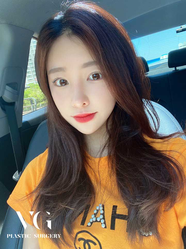 깊은 이마주름, 피곤해보이는 눈매, 내시경 이마리프팅으로 한번에! 관련 이미지 1