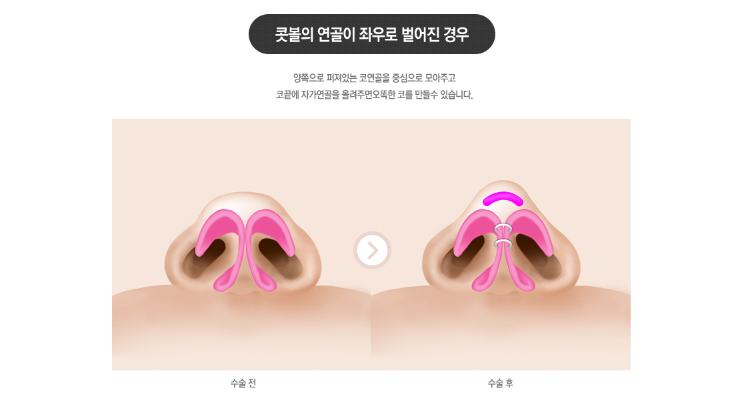 [ 베리굿성형외과 ] 베일듯한 코라인 베리굿 복코 찐 전후비교 관련 이미지 4