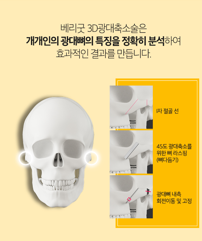 광대축소술 작고 부드러운 얼굴라인 관련 이미지 3