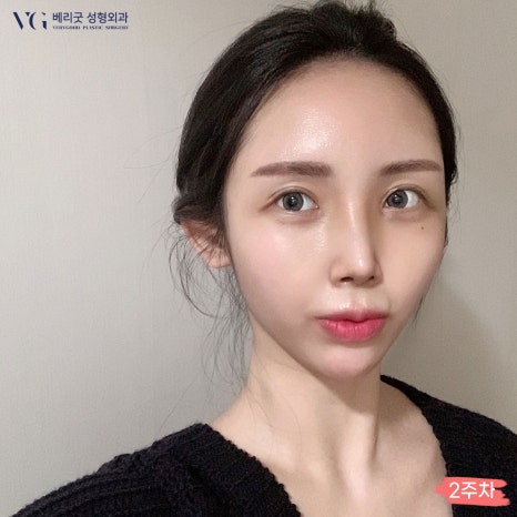 베리굿성형외과 기증늑연골 짧은코교정💖 관련 이미지 3