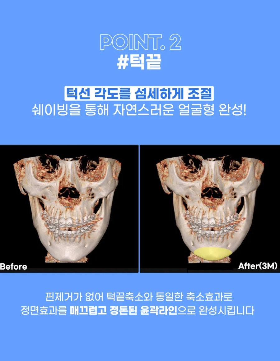 회복기간 빠르고 붓기적은 안면윤곽 원한다면 , 연예인 핀없는 안면윤곽 관련 이미지 9