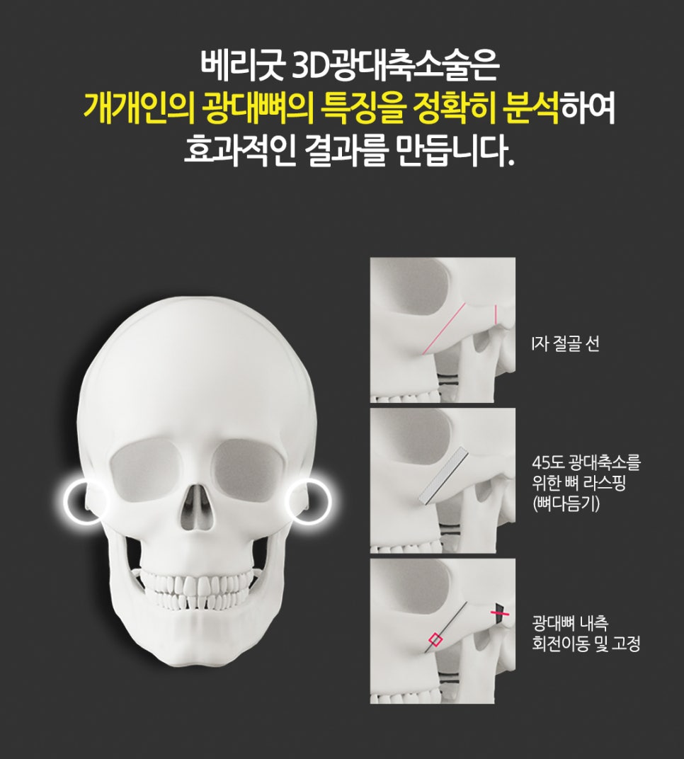 얼굴 작아지는법/ 베리굿성외과 3D광대축소술180만원 /강남역성형외과/강남역위치 관련 이미지 4