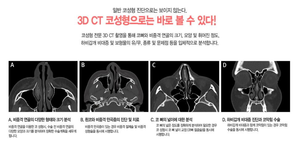 베리굿성형외과 기증늑연골 짧은코교정💖 관련 이미지 11
