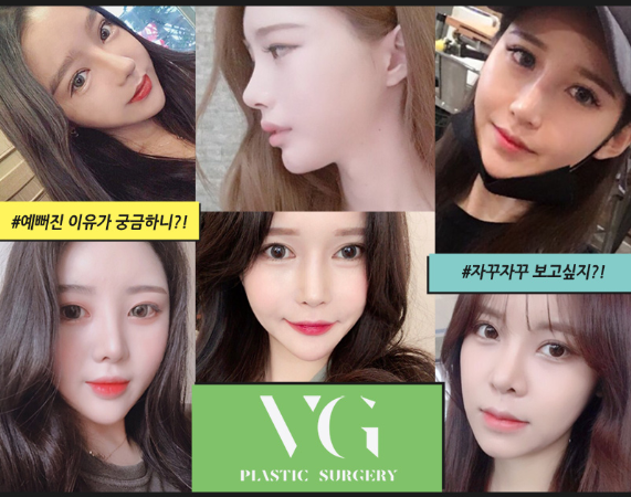 베리굿성형외과에서 이마리프팅하고 어려보이고 또렷해보이는 인상으로 change! 관련 이미지 8