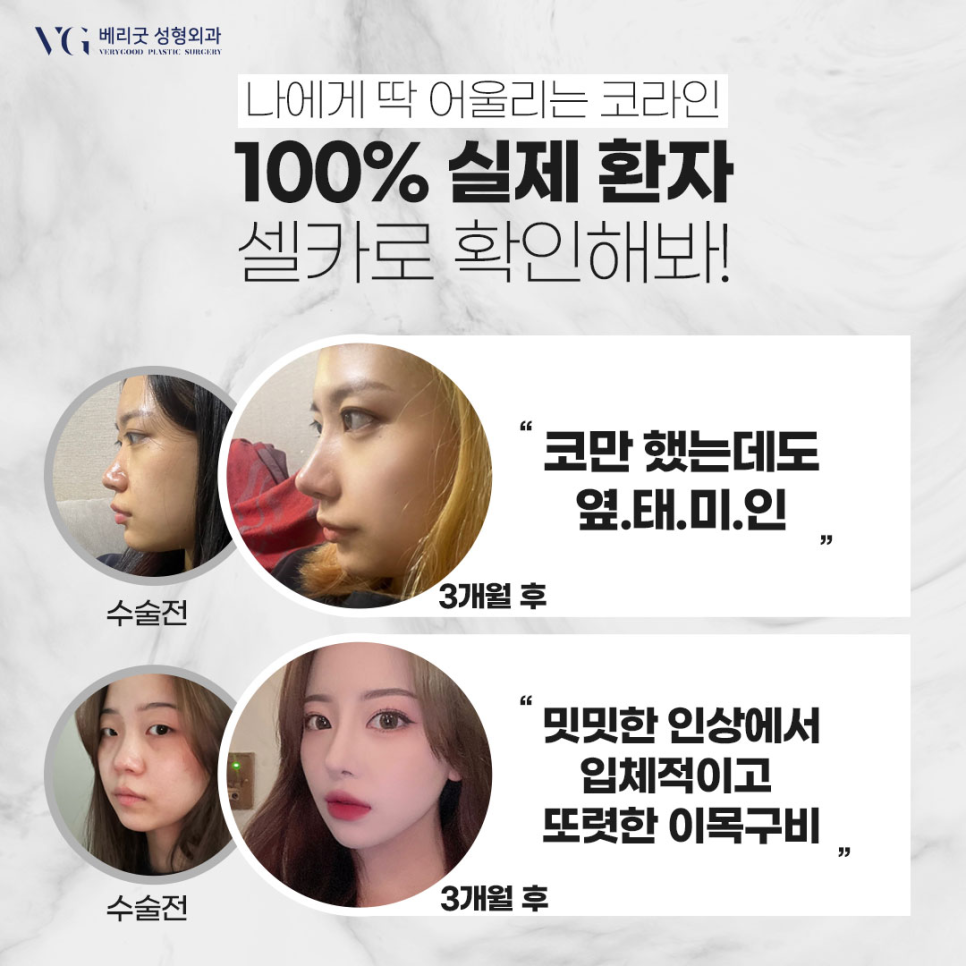 눈코수술후기 , 붓기 쌍수 코성형 회복기간 궁금하다면 관련 이미지 10