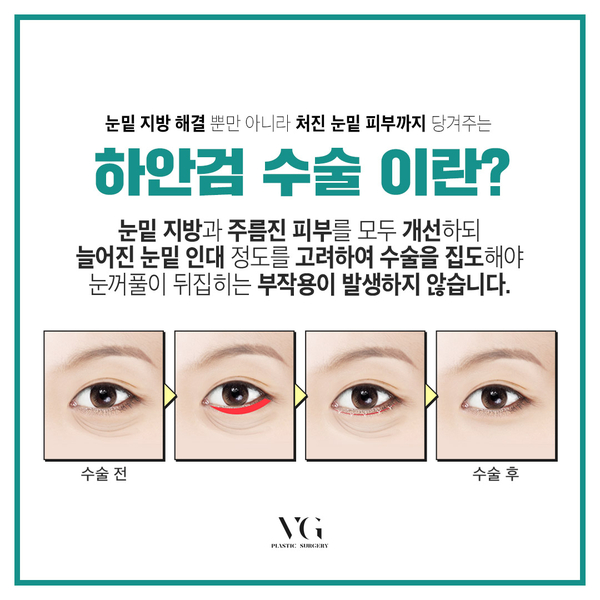 중년 하안검수술 정확한 진단으로 확실히 개선하자. 관련 이미지 3
