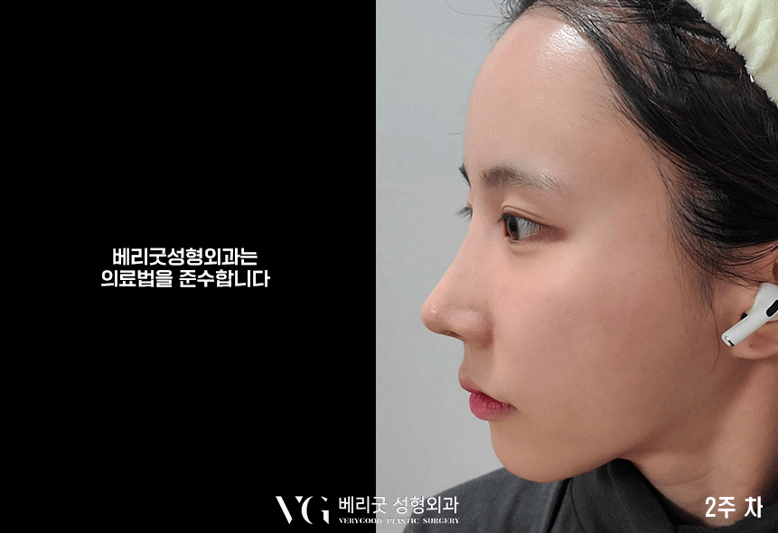 낮은 콧대 모여라❣❣ 베리굿 코끝성형으로 예뻐지자✨ 관련 이미지 2