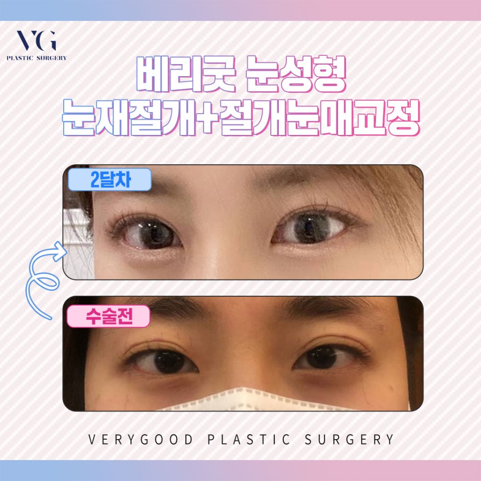 눈재수술도 베리굿하게😍베리굿성형외과 관련 이미지 3