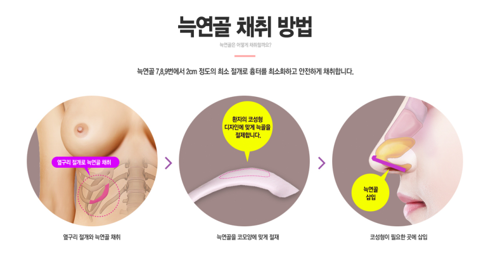 자가 늑연골 코재수술로 완벽해지자! 관련 이미지 5