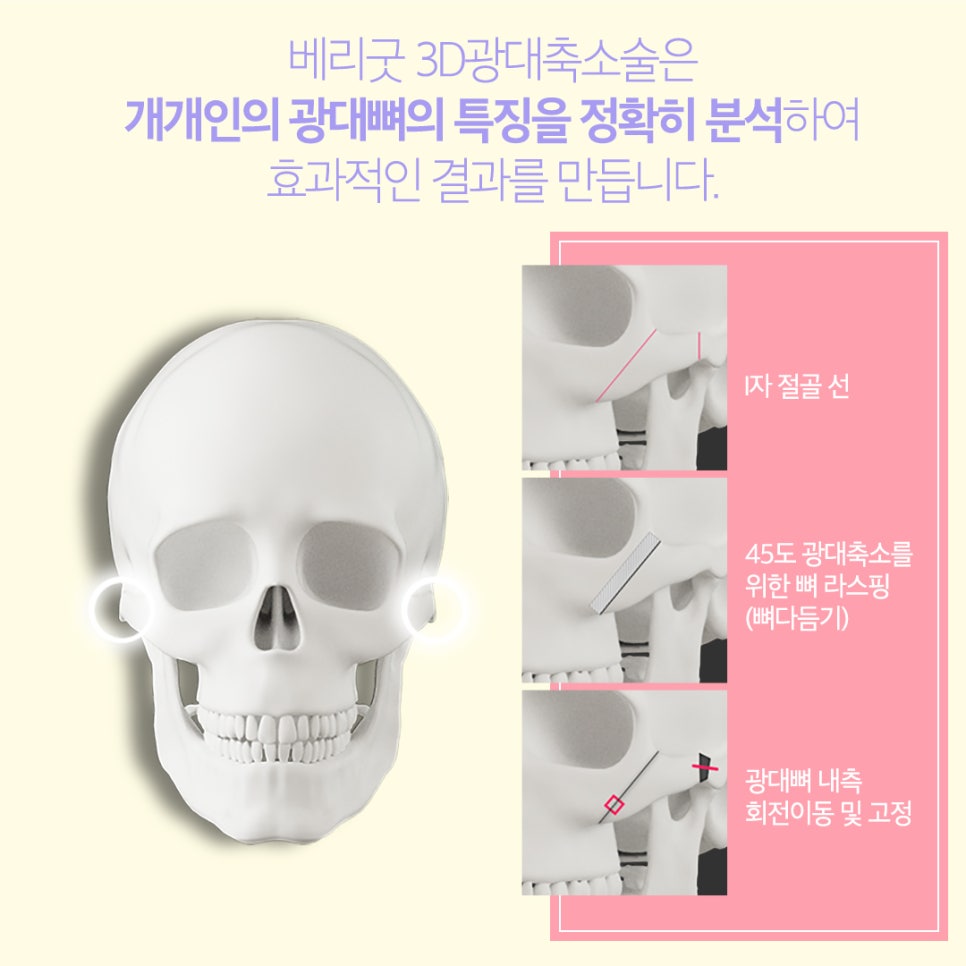 베리굿 안면윤곽3종으로 예쁜 얼굴형으로! 관련 이미지 6