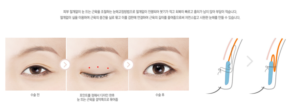 안검하수, 눈매교정으로 개선할수있다? 관련 이미지 3
