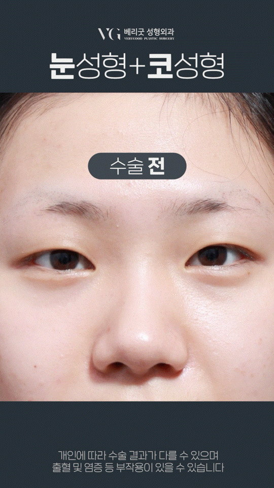 눈코수술후기 , 붓기 쌍수 코성형 회복기간 궁금하다면 관련 이미지 13