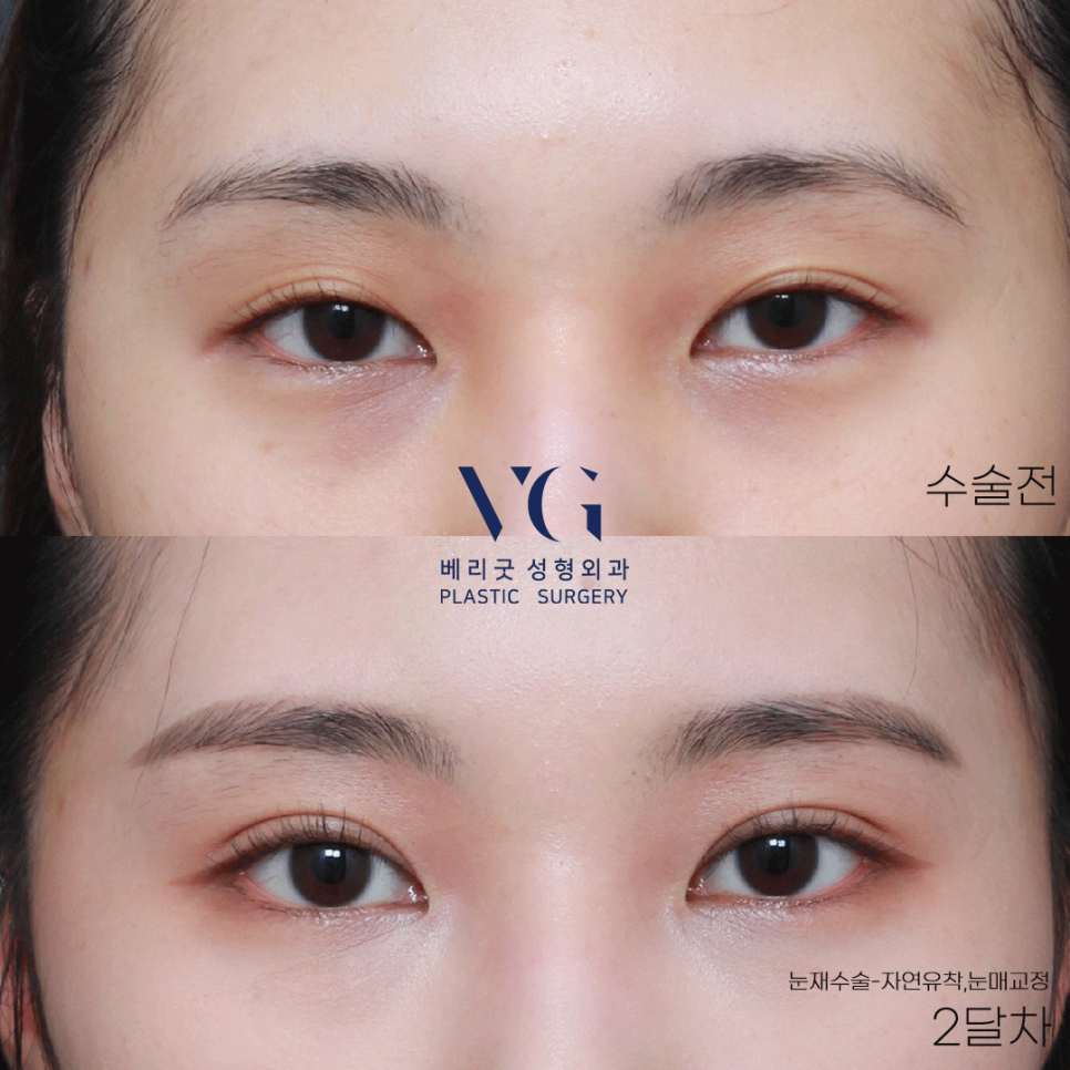 베리굿하게💖베리굿성형외과 눈성형전후 관련 이미지 7