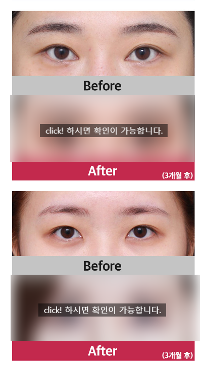 시원한 눈매? 베리굿 트리플 트임 관련 이미지 5