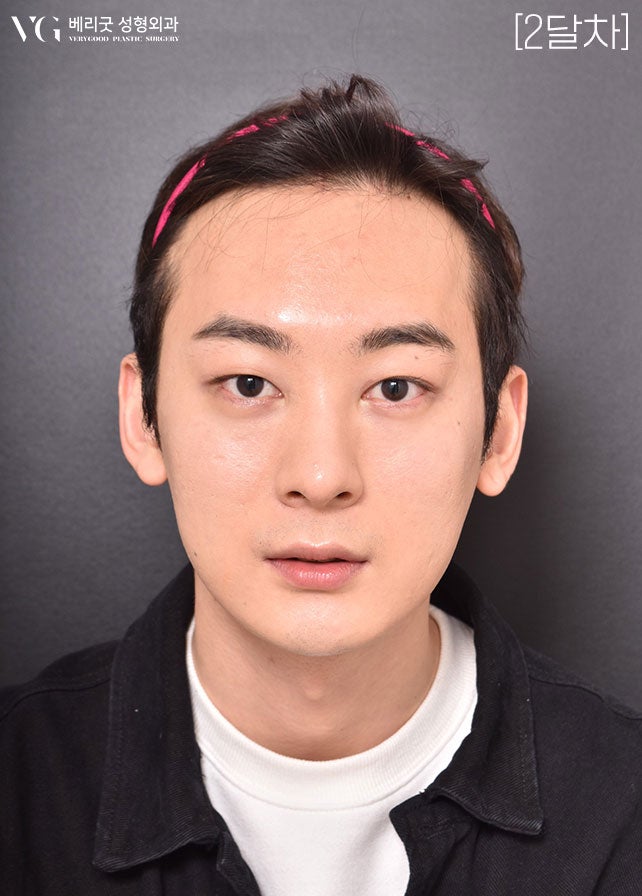[베리굿성형외과]안면윤곽 리얼전후! 관련 이미지 14