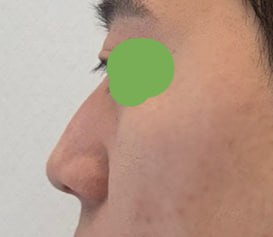 Primary Rhinoplasty, Tip Surgery, Osteotomy, Hump Correction, Donor Rib Cartilage | 베리굿성형외과 Before-and-After Review image 1