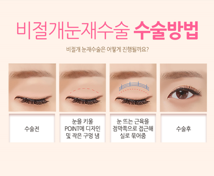 나의 마지막 눈성형 쌍꺼풀재수술! 어디에서 해야할까?? 관련 이미지 5