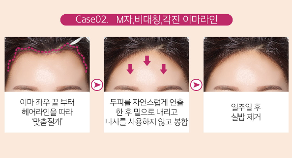 이마축소로 작고 아름다운 얼굴라인으로 변신! 관련 이미지 6