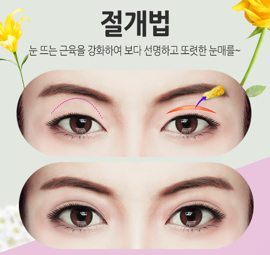 내게 맞는 라인으로 쌍꺼풀수술 잘하는곳 관련 이미지 3