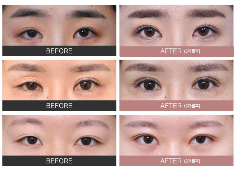 실패 없는 자연스러운 쌍꺼풀을 위한 선택 , 강남역눈재수술 잘하는 병원 관련 이미지 4