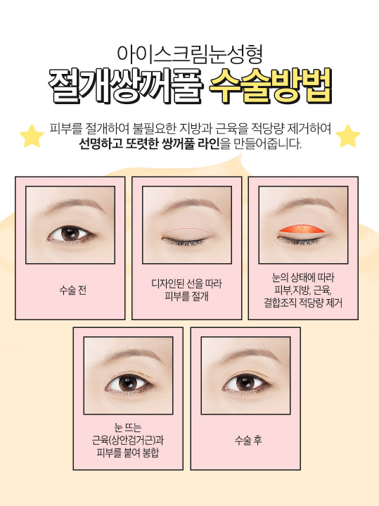선명하고 또렷한 눈매를 원한다면 절개눈성형 관련 이미지 3