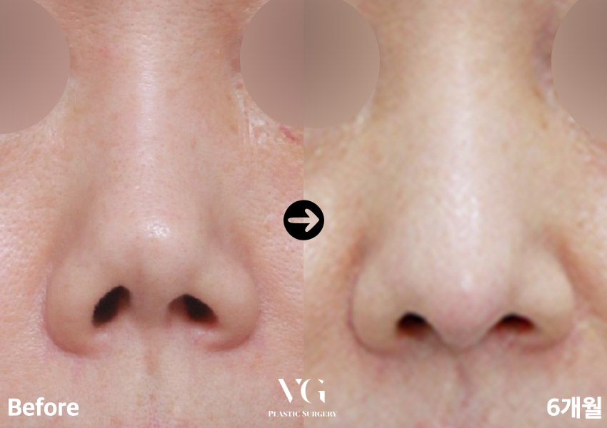 실패한 구축코재수술 베리굿에서 👨&zwj;⚕️✨ 관련 이미지 9