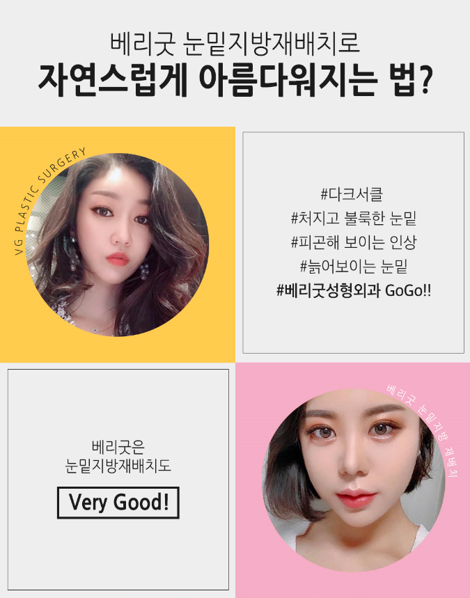 눈밑지방재배치수술로 팬더탈출! 재발없는 수술하는법? 관련 이미지 3