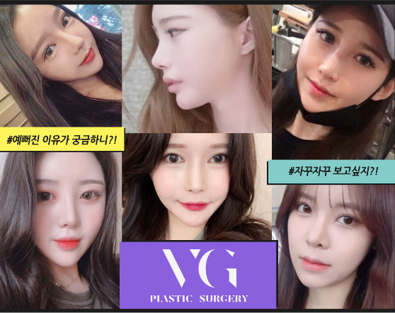 풀페이스지방이식, 베리굿성형외과에서 동안페이스로 거듭나자! 관련 이미지 10