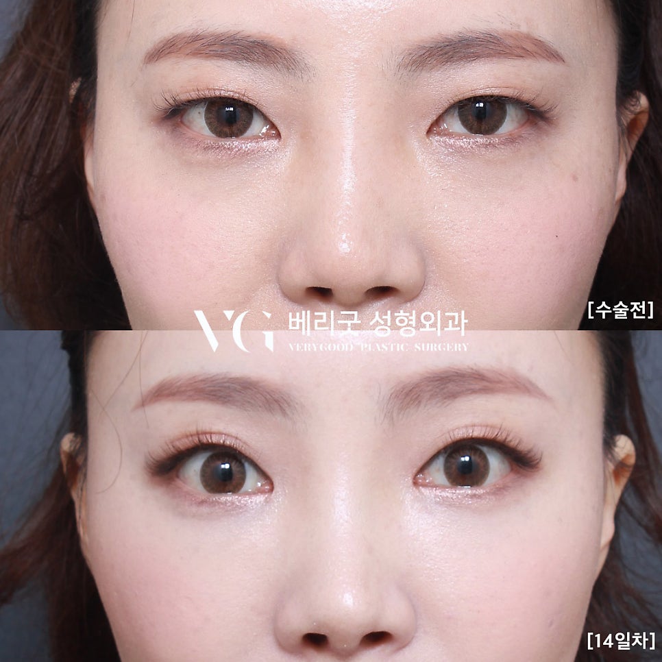 강남역 이마거상 전후, 베리굿성형외과💖 관련 이미지 4