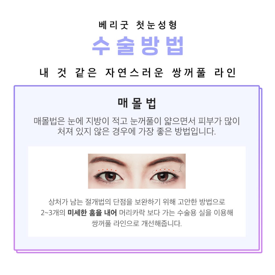 아름다운 당신을 위한 베리굿의 첫눈성형 관련 이미지 2