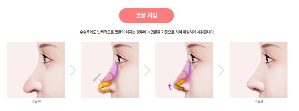 코끝도 베리굿💯#자가늑연골 #반버선 #직반버선 #베리굿성형외과 관련 이미지 5