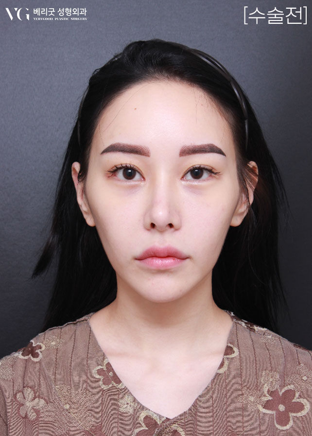 [베리굿성형외과]안면윤곽 리얼전후! 관련 이미지 2