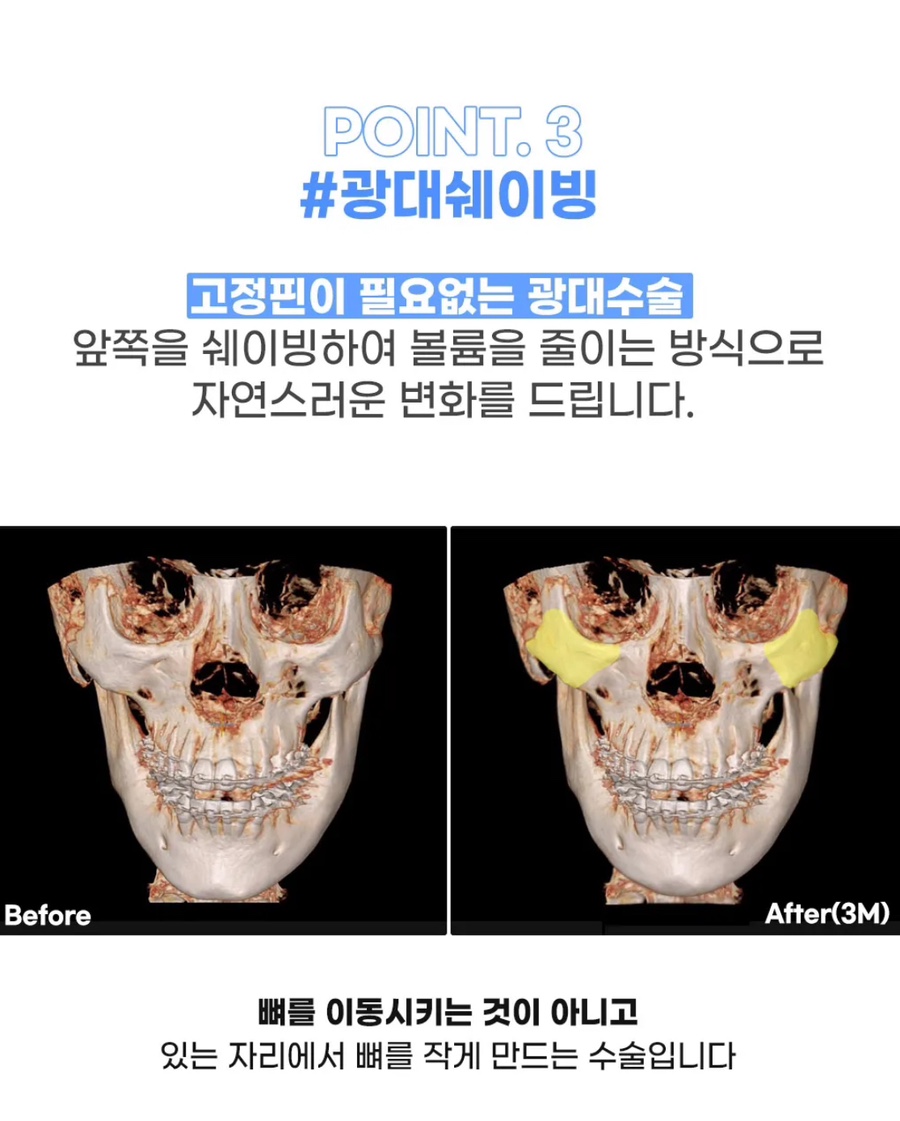 회복기간 빠르고 붓기적은 안면윤곽 원한다면 , 연예인 핀없는 안면윤곽 관련 이미지 10