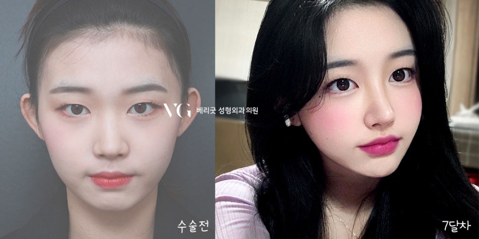 교정 없이! 발치 없이! 코성형으로 돌출입교정하자 ❤베리굿성형외과❤ 관련 이미지 9