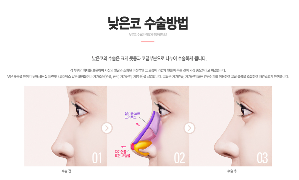 낮은 콧대 모여라❣❣ 베리굿 코끝성형으로 예뻐지자✨ 관련 이미지 4