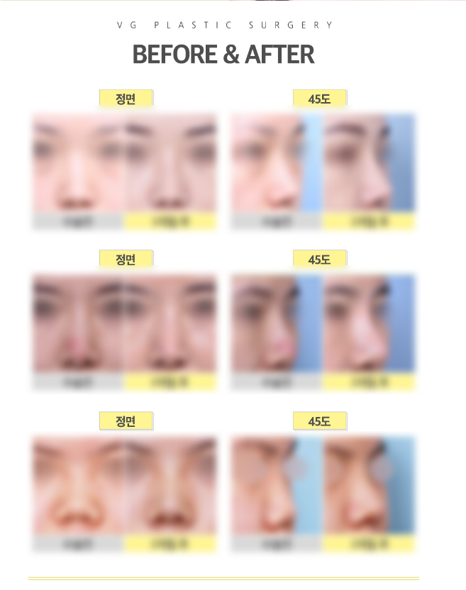 높기만한코는 이제 NO! 코성형잘하는곳! 어디일까?? 관련 이미지 6