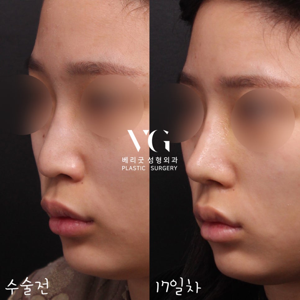 직반코성형전후💖베리굿성형외과 관련 이미지 1