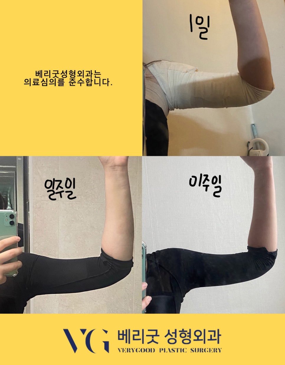 베리굿성형외과에서 뼈팔 만들기🔥베리굿 지방흡입 전후 관련 이미지 7