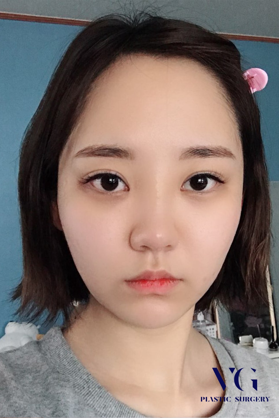 넓은 이마고민, 이마축소로 얼만큼 줄일 수 있을까?? 베리굿 이마축소후기로 확인하자! 관련 이미지 2