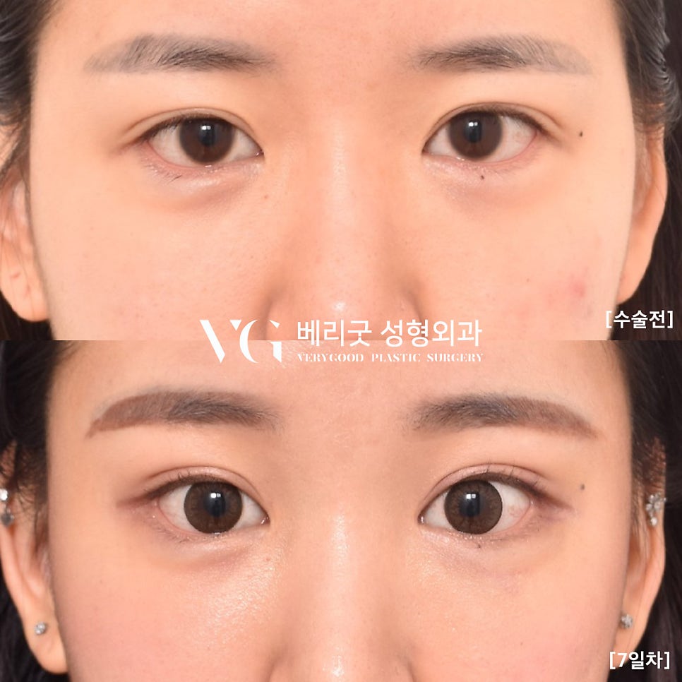 강남역 이마거상 전후, 베리굿성형외과💖 관련 이미지 1