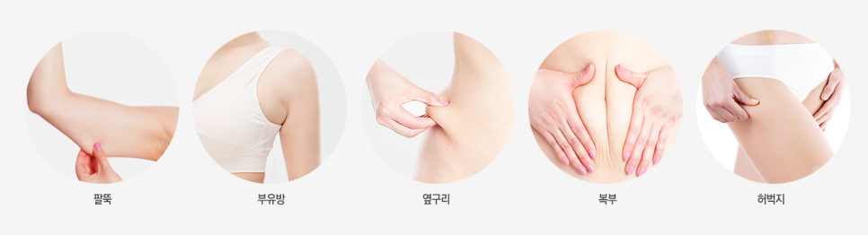 베리굿성형외과에서 뼈팔 만들기🔥베리굿 지방흡입 전후 관련 이미지 2