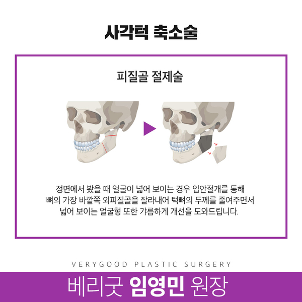 사각턱축소술 수술방법부터 주의사항까지 확실하게 관련 이미지 10