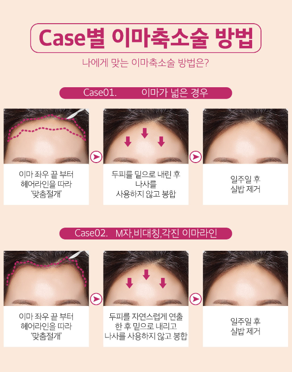 이마축소로 이상적인 이마높이 완성! 관련 이미지 5