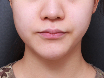 사각턱축소술로 안면 비대칭교정도 가능하다?? 관련 이미지 3