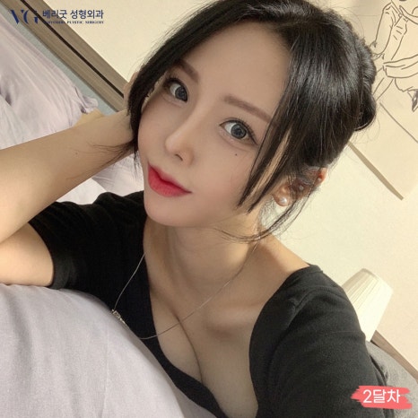 베리굿성형외과 기증늑연골 짧은코교정💖 관련 이미지 4